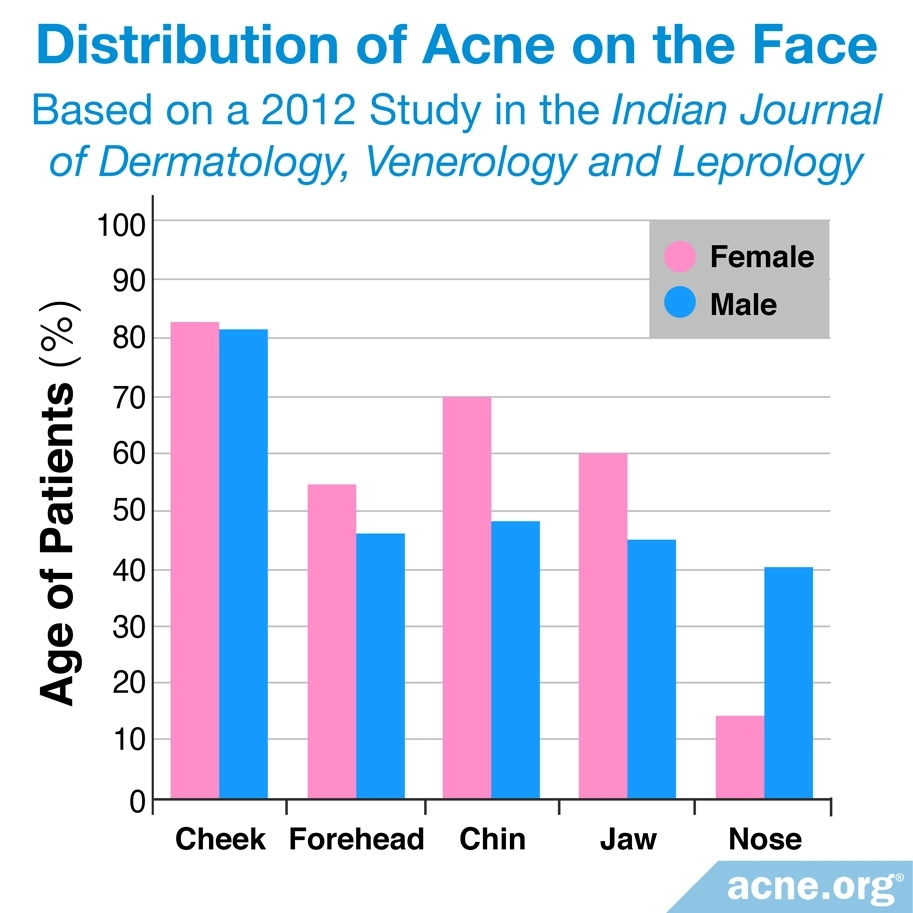 Distribution of Acne on Face: By Gender