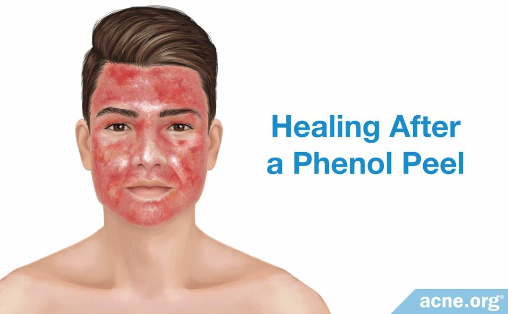 Healing After a Phenol Peel