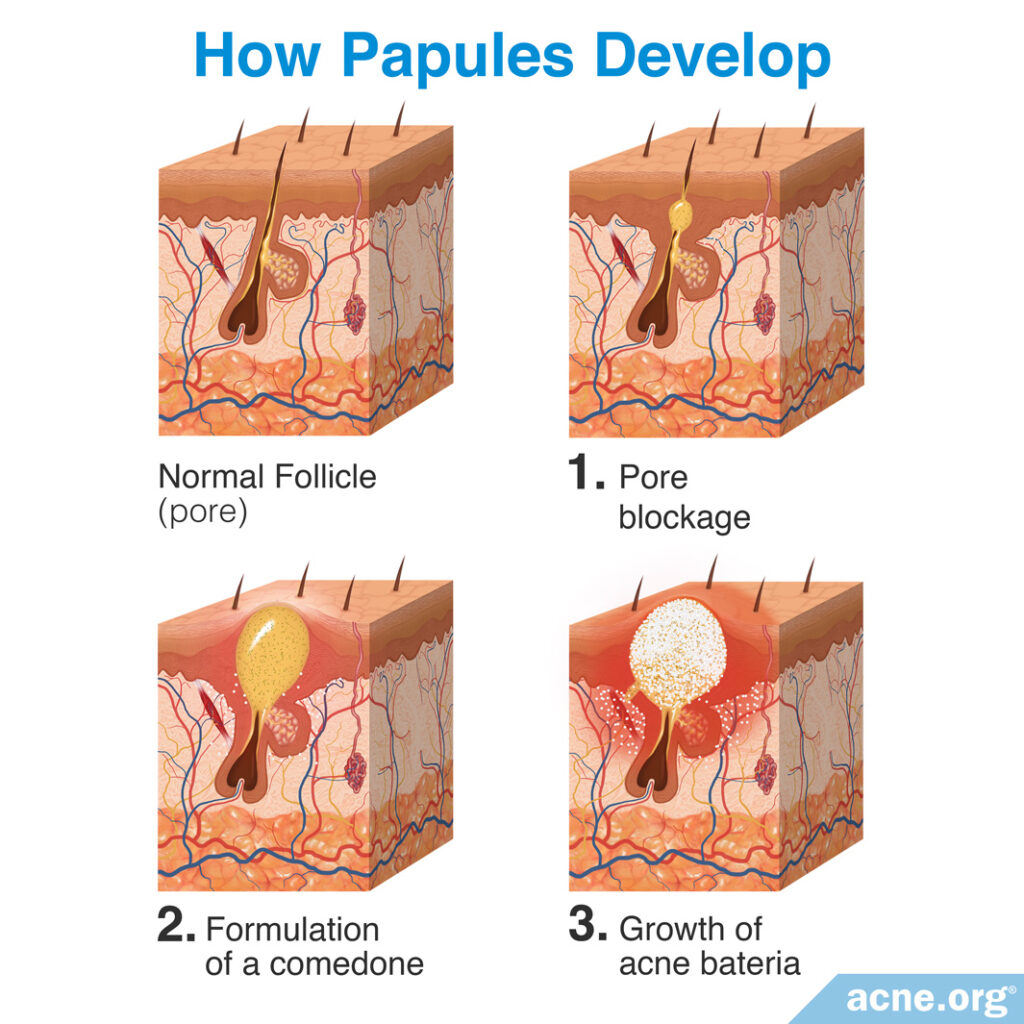 How Papules Develop