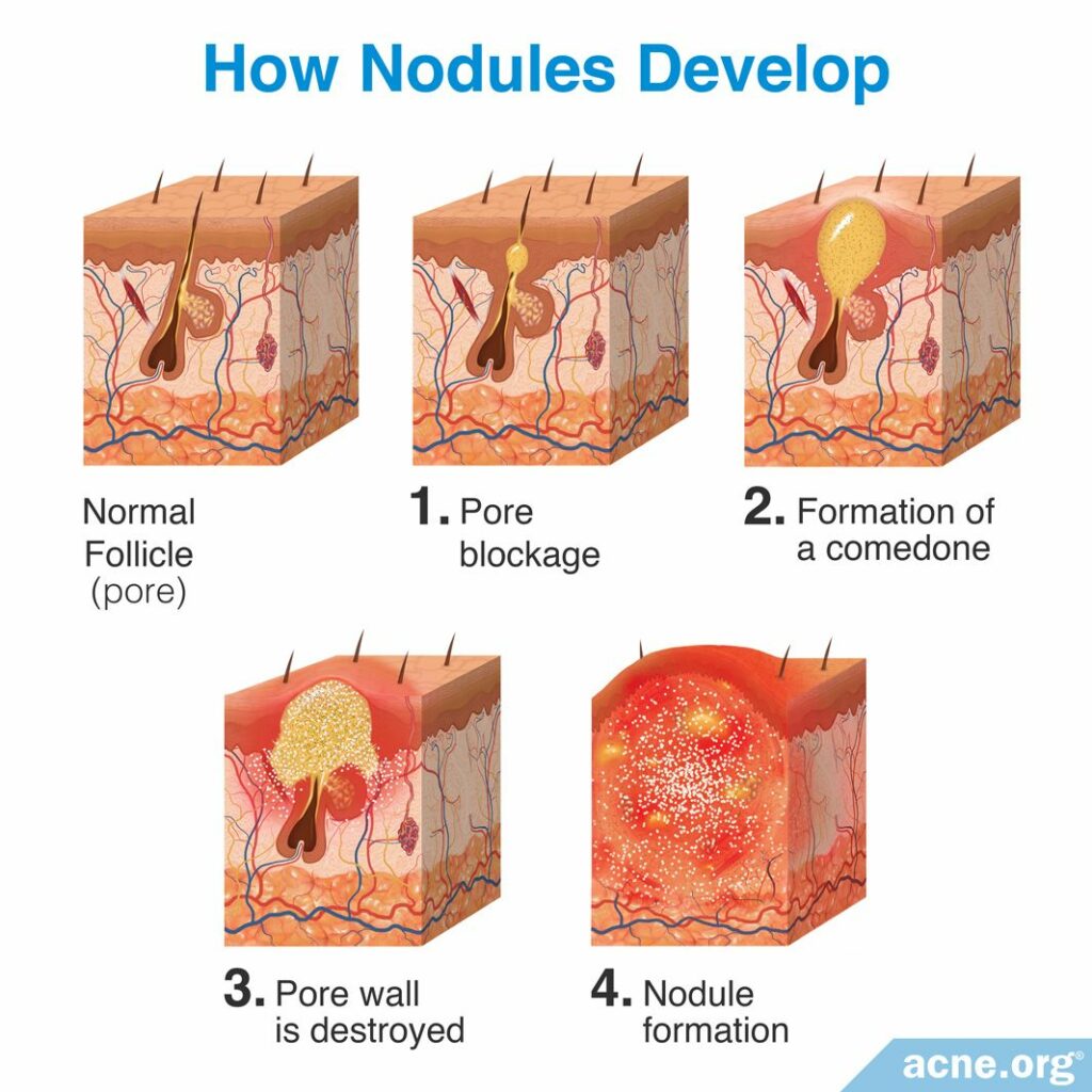 How Nodules Develop