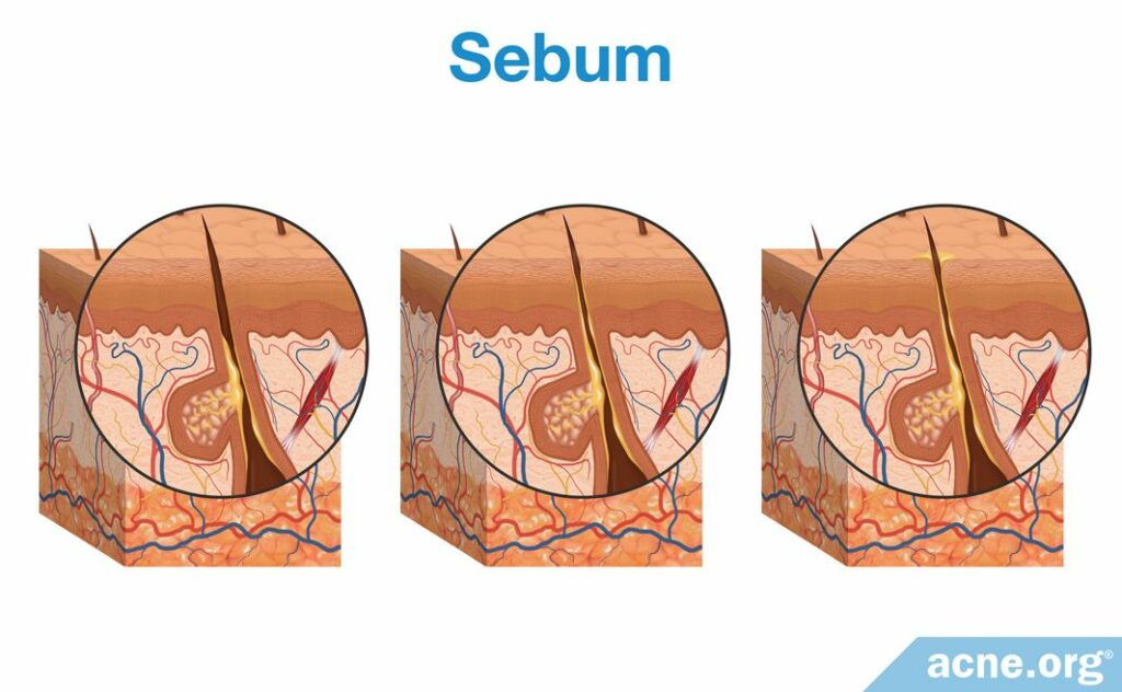 Sebum Development in the Pore