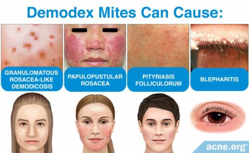 What Are Demodex Mites, and What Role Do They Play in Acne? - Acne.org