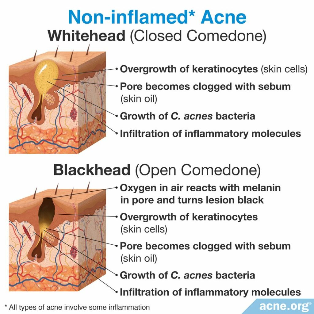 Non-inflamed Acne