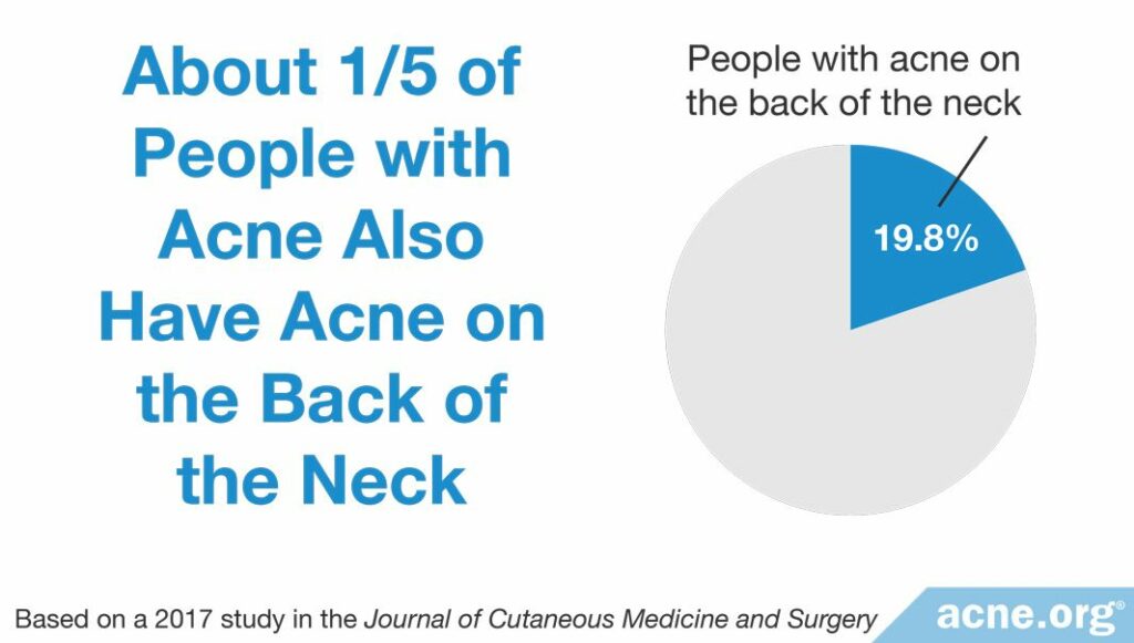 About 1/5 of people with acne also have acne on the back of the neck