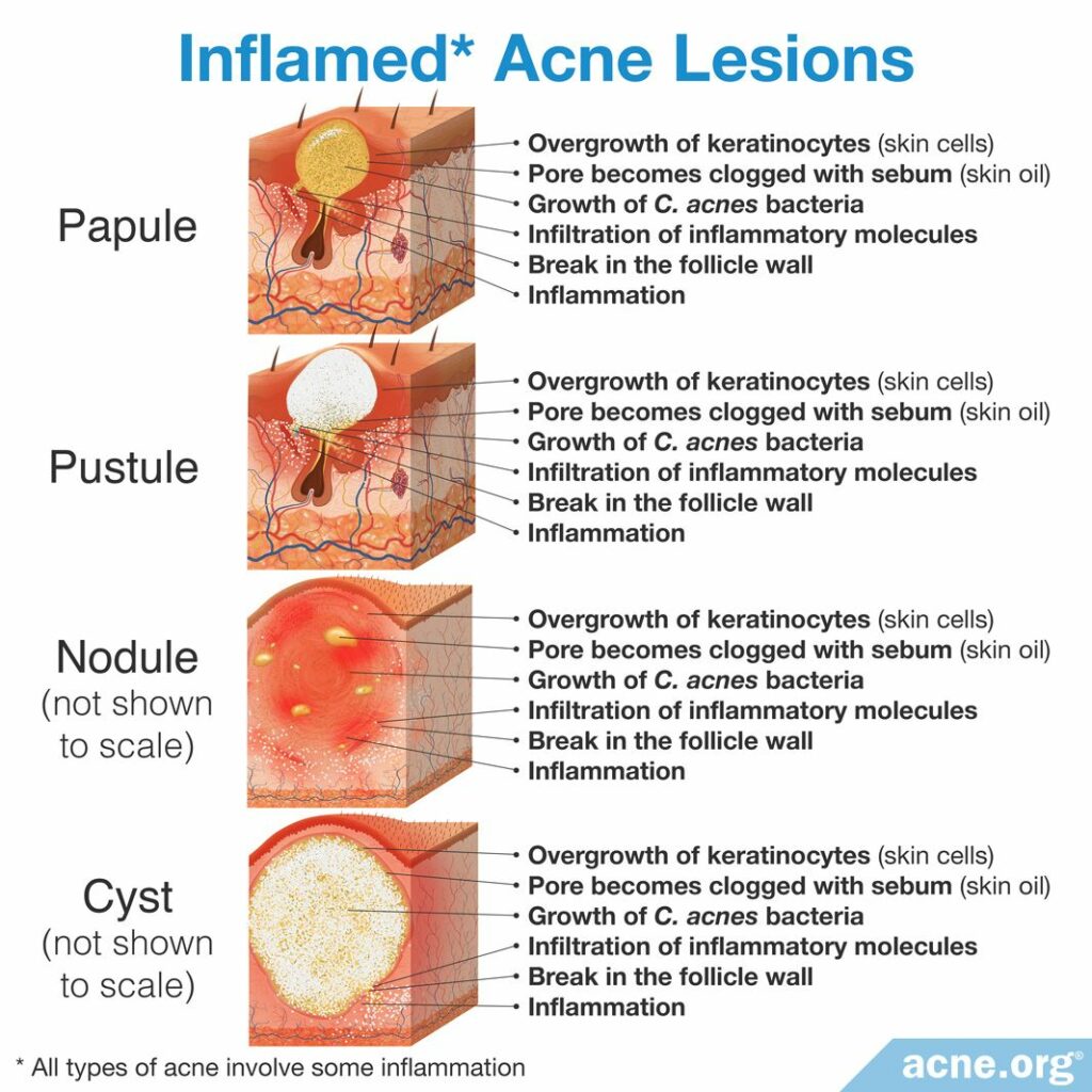 Inflamed Acne Lesions