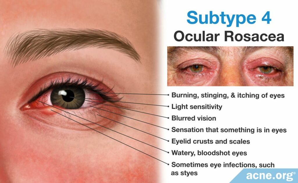 Subtype 4: Ocular Rosacea