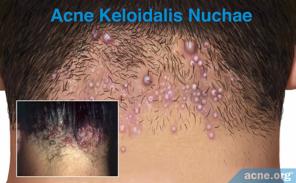 Acne Keloidalis Nuchae