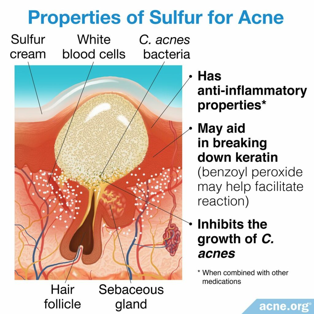 Properties of Sulfur for Acne