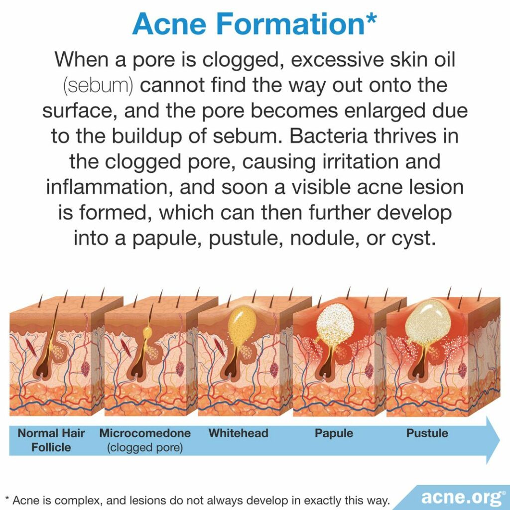 Acne Formation