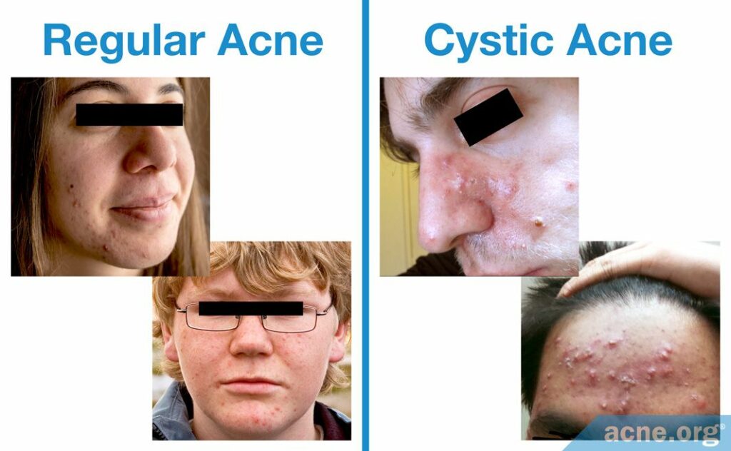 Regular Acne Vs. Cystic Acne