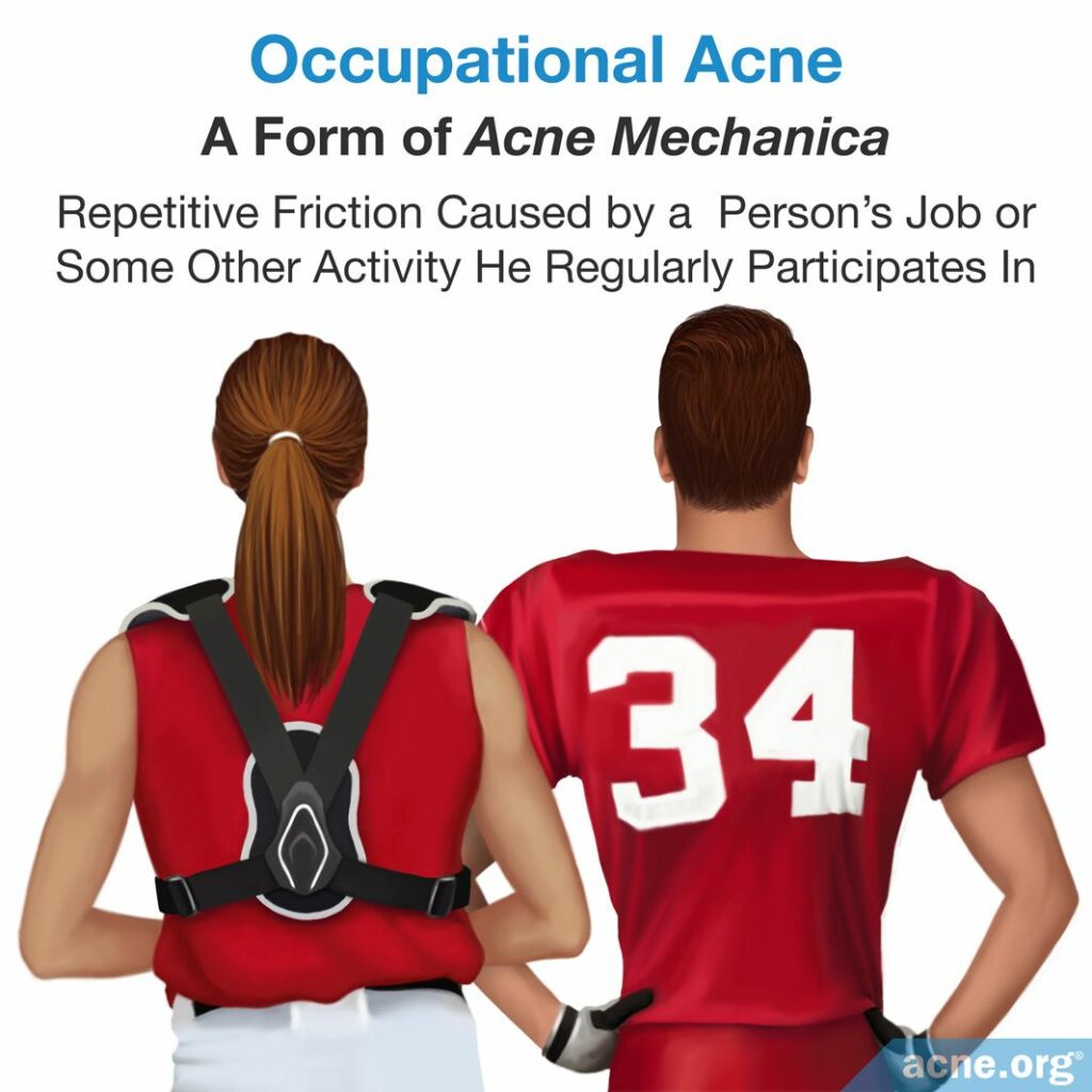 Occupational Acne - A Form of Acne Mechanica