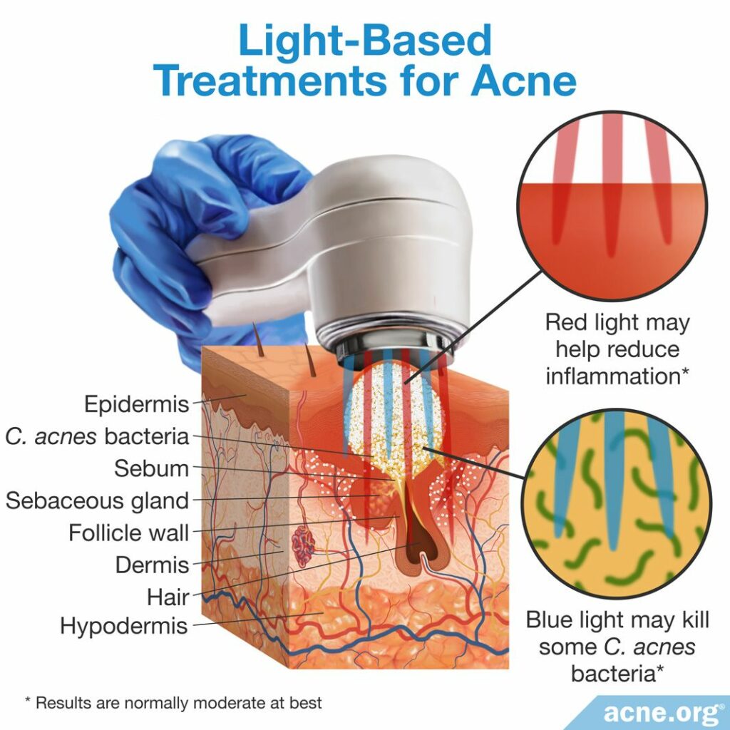 Light-Based Treatments for Acne