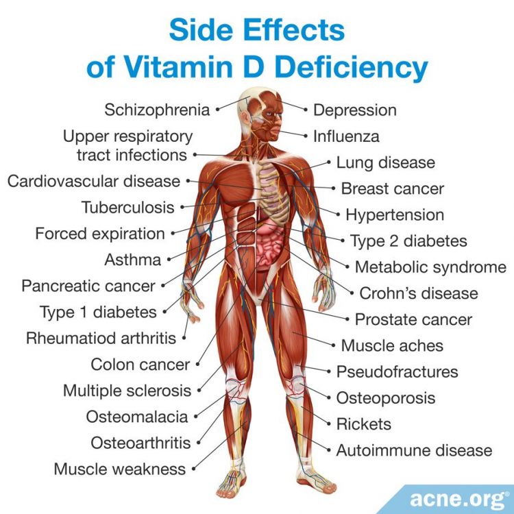 Side effects of Vitamin D Deficiency