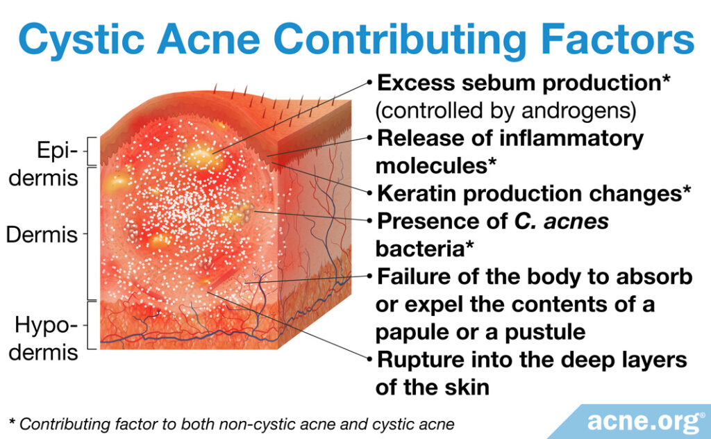 Cystic Contributing Factor