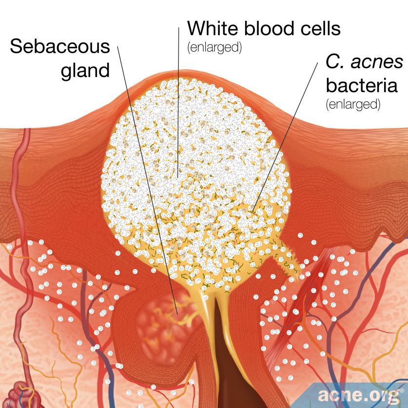 C. acnes Bacteria Inside a Skin Pore