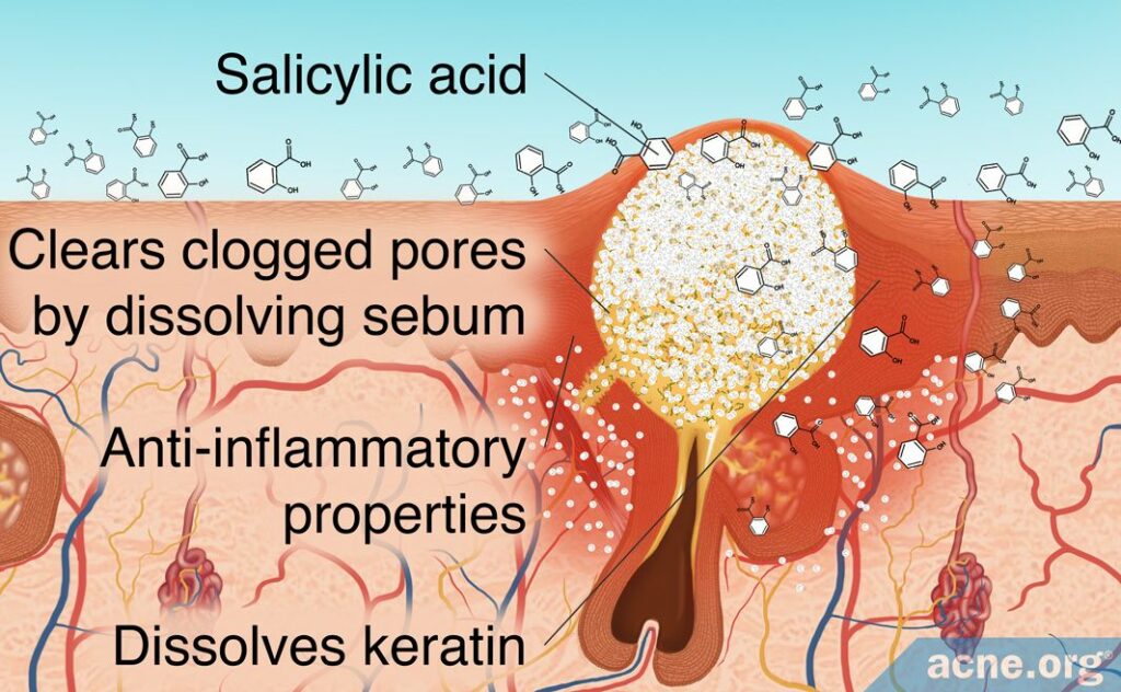 Salicylic acid clears clogged pores, has inflammatory properties, dissolves keratin