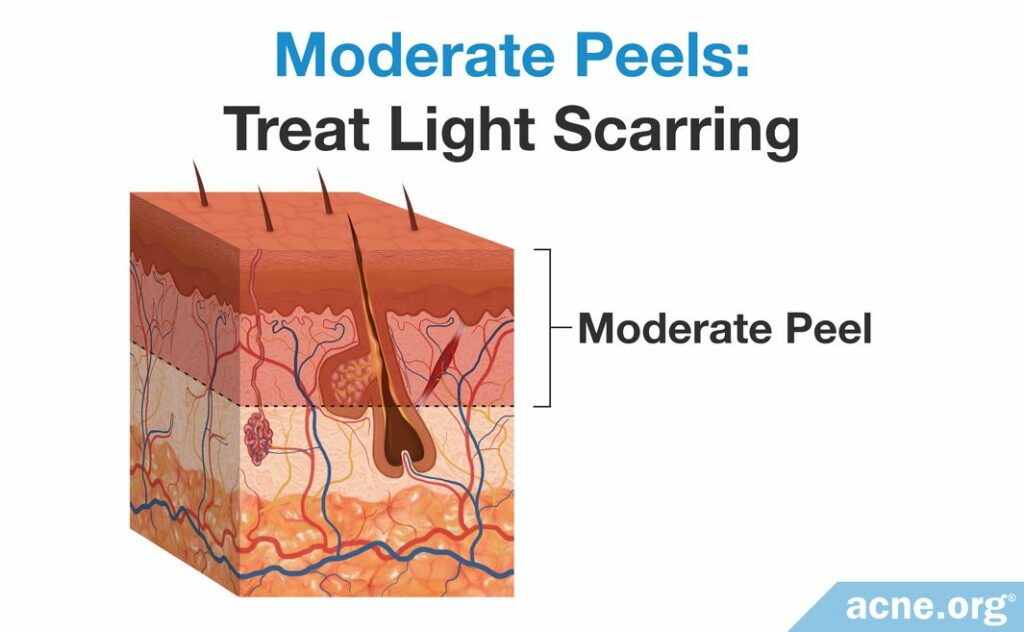 Moderate Chemical Peels - Treat Light Scarring