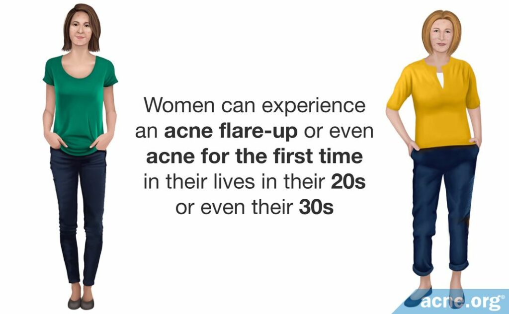 Women can experience an acne flare-up or even acne for the first time in their lives in their 20s or even their 30s