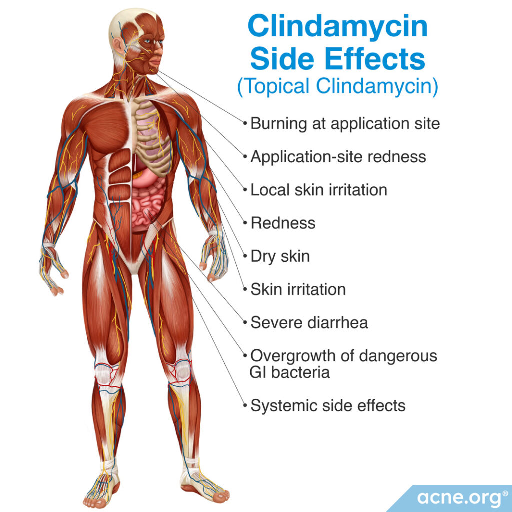 Clindamycin Side Effects (Topical Clindamycin)