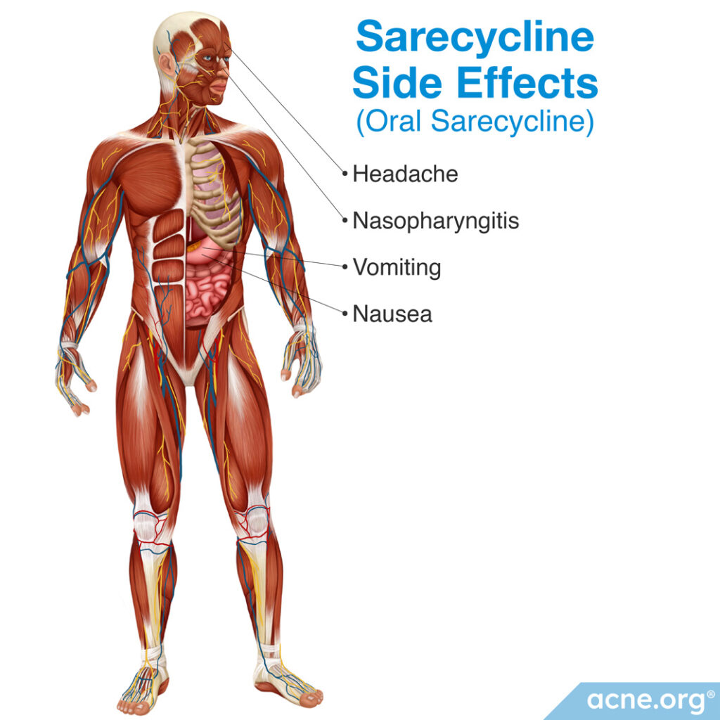 Sarecycline Side Effects (Oral Sarecycline)