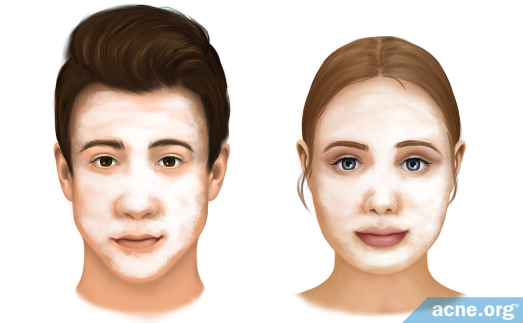 Treating Acne in Male vs. Female Skin