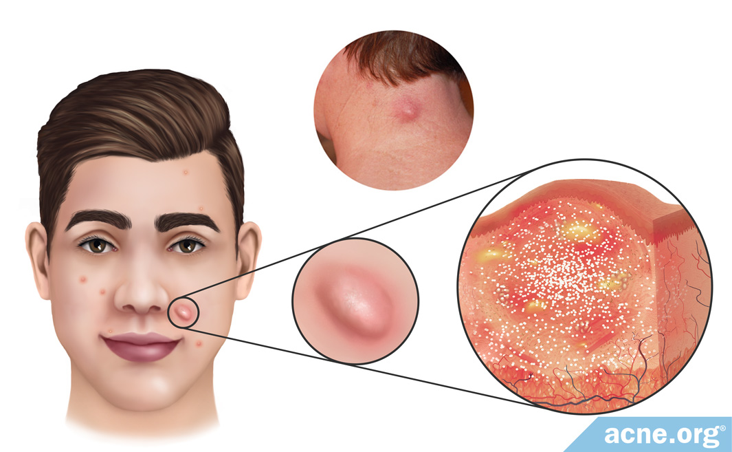 acne nodule vs cyst