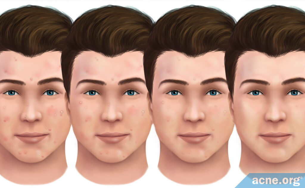 How Do Acne Lesions Heal?