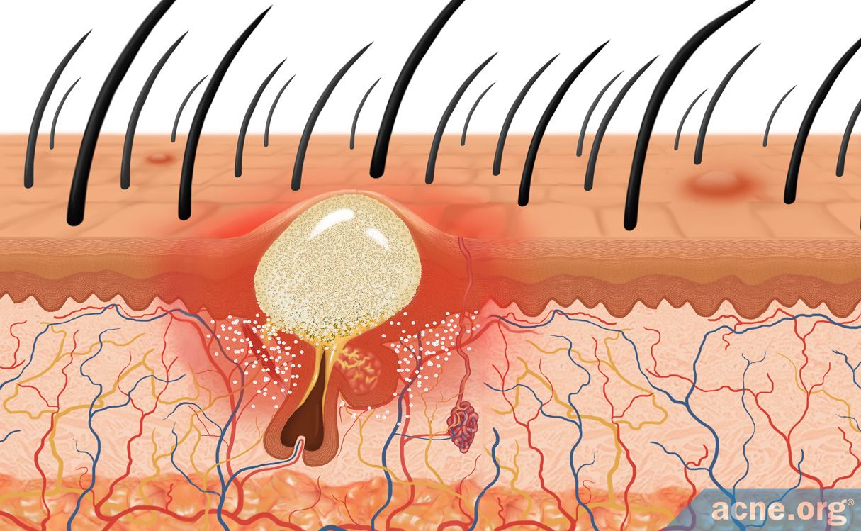 Scalp Acne