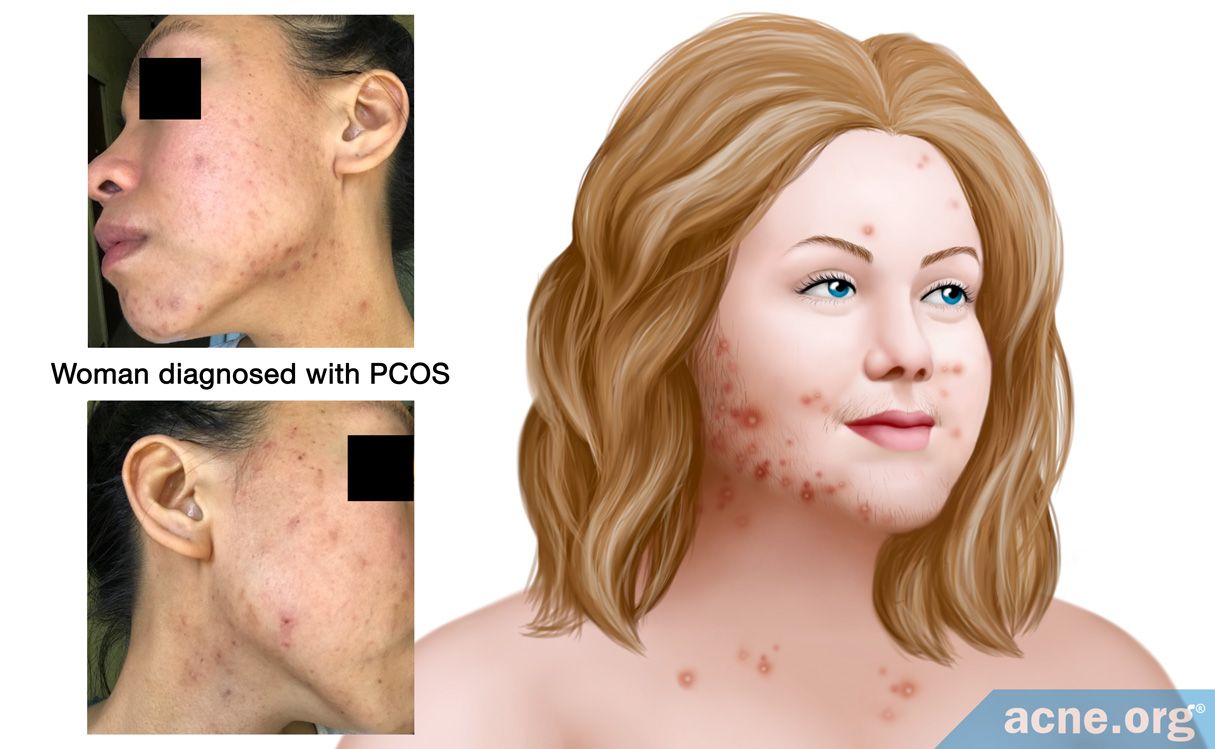 polycystic ovarian syndrome acne