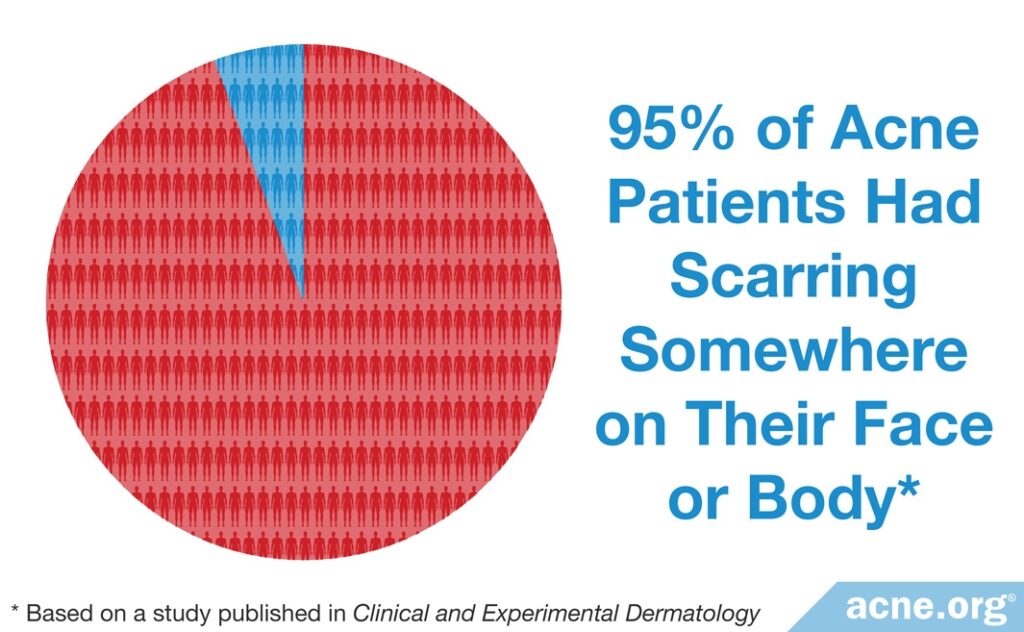 95% of Acne Patients Had Scarring Somewhere on Their Face or Body