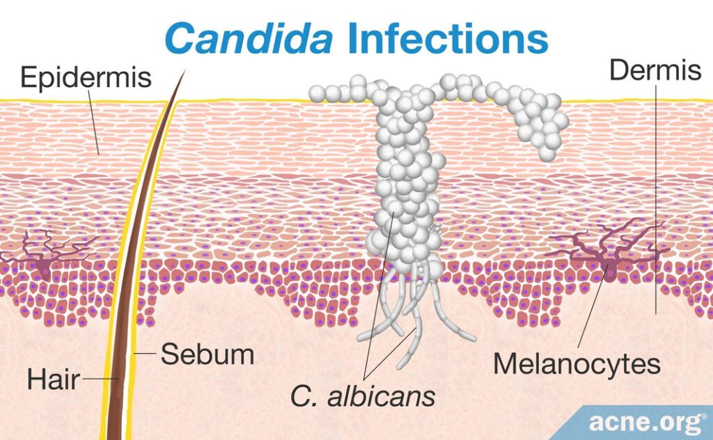 Candida Infections