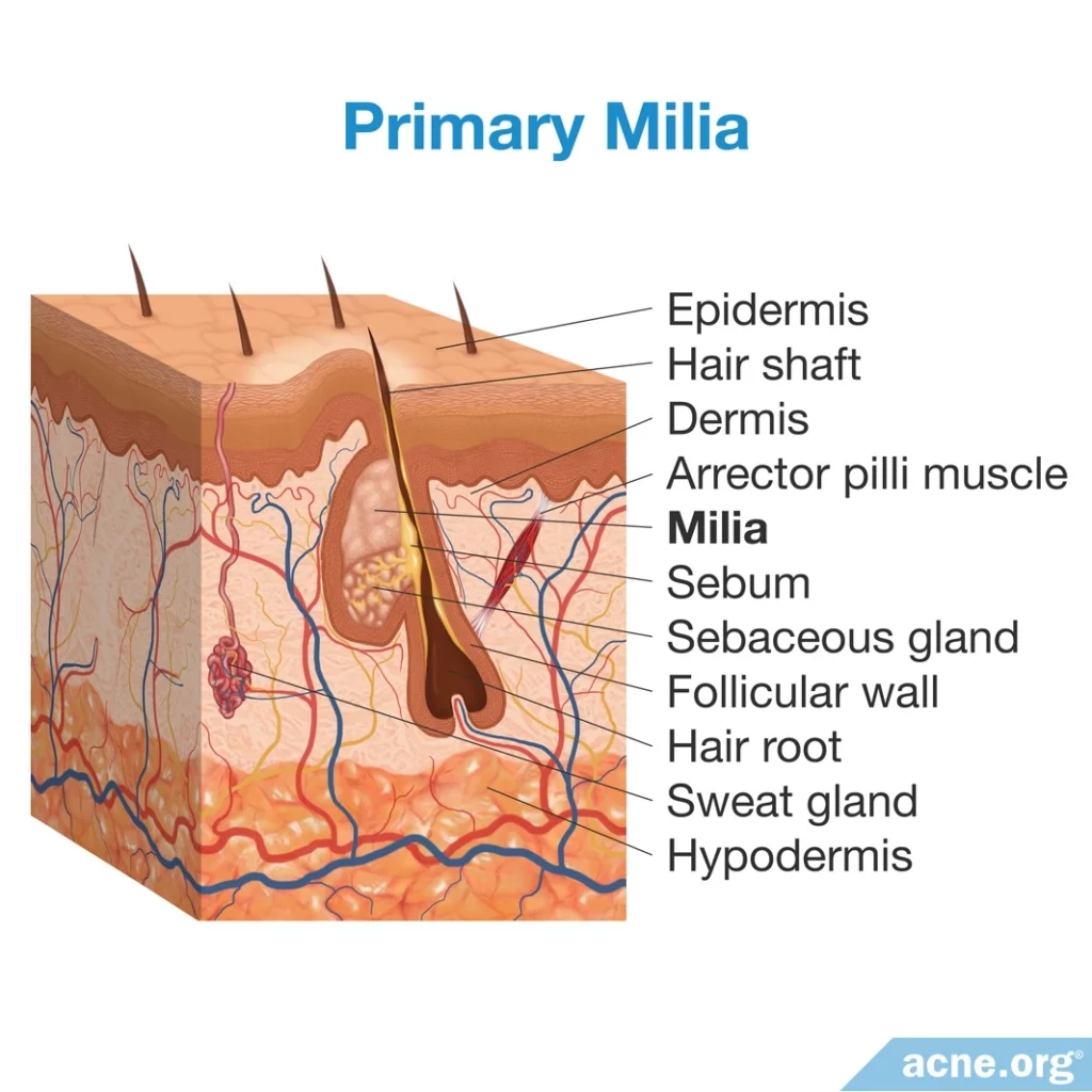 Primary Milia