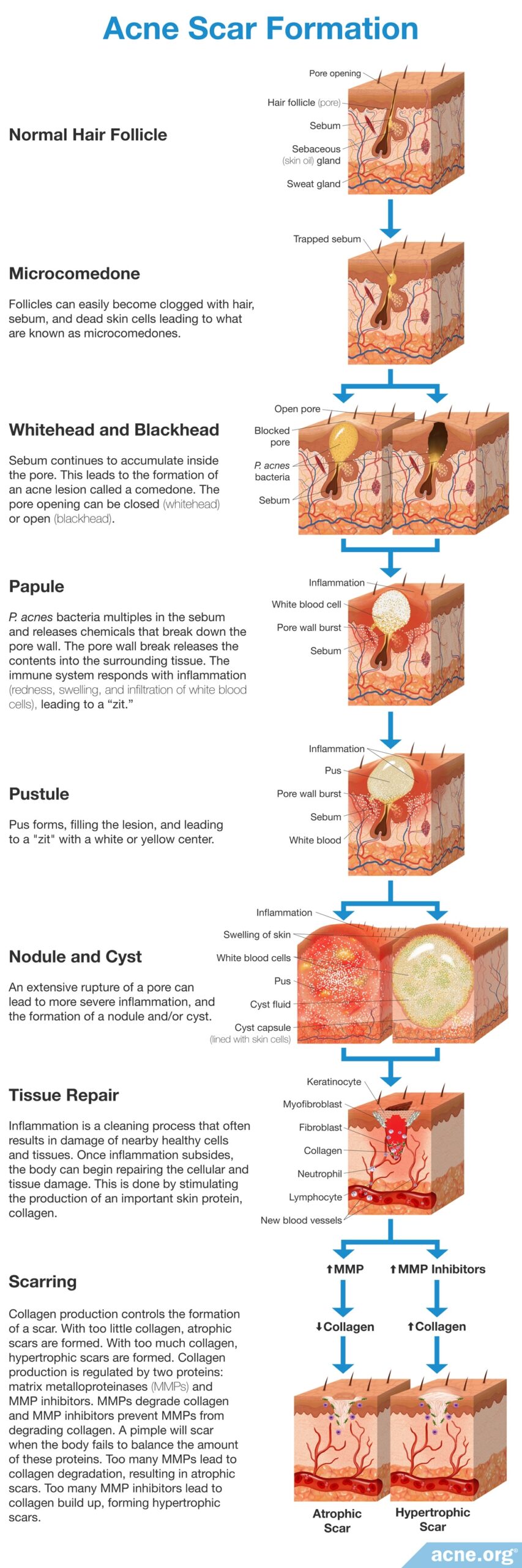 Acne Scar Formation
