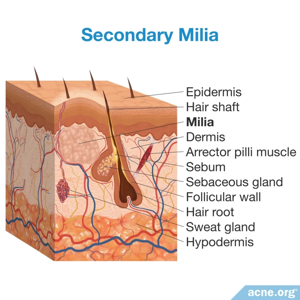 Secondary Milia