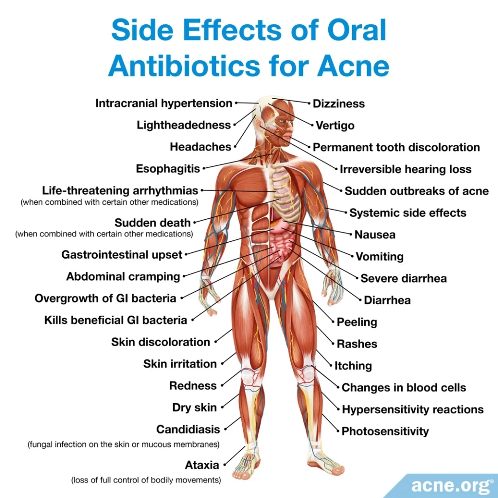 Efectos secundarios de los antibióticos orales para el acné