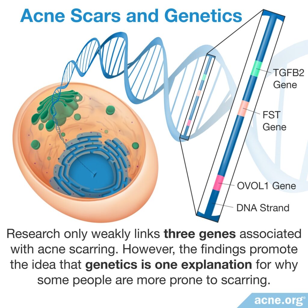 Acne Scars and Genetics
