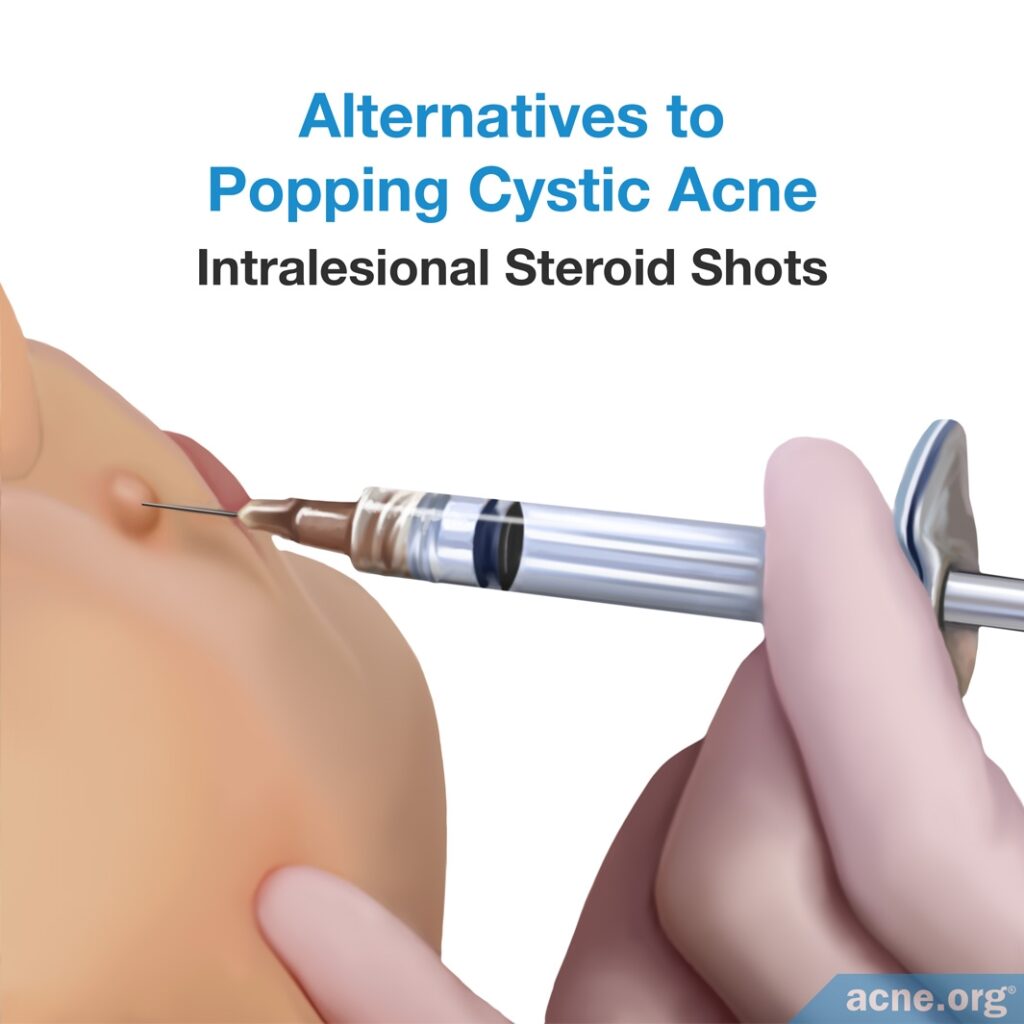 Alternatives to Popping Cystic Acne - Intralesional Steroid Shots