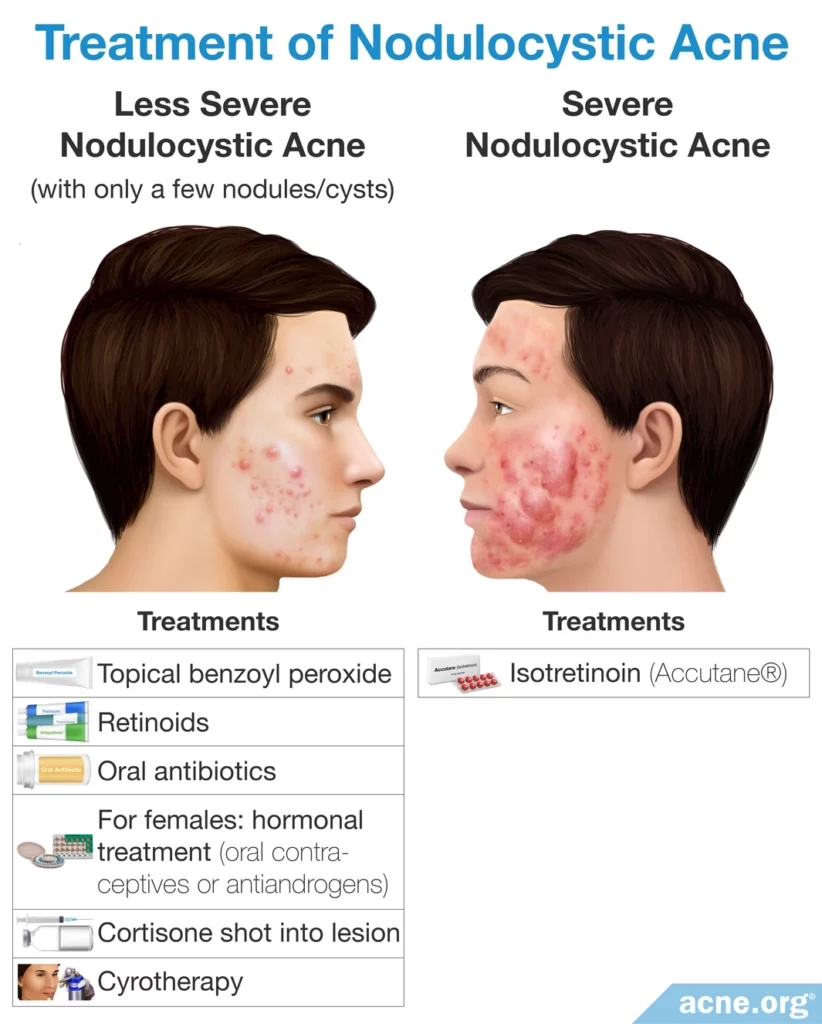 Tratamiento del acné noduloquístico