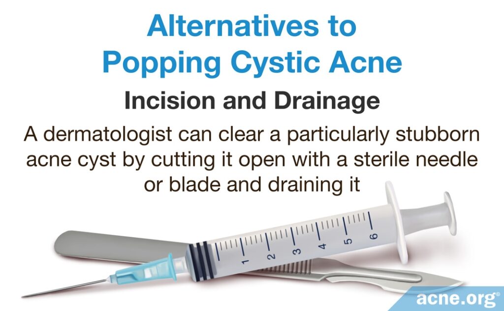 Alternatives to Popping Cystic Acne - Incision and Drainage