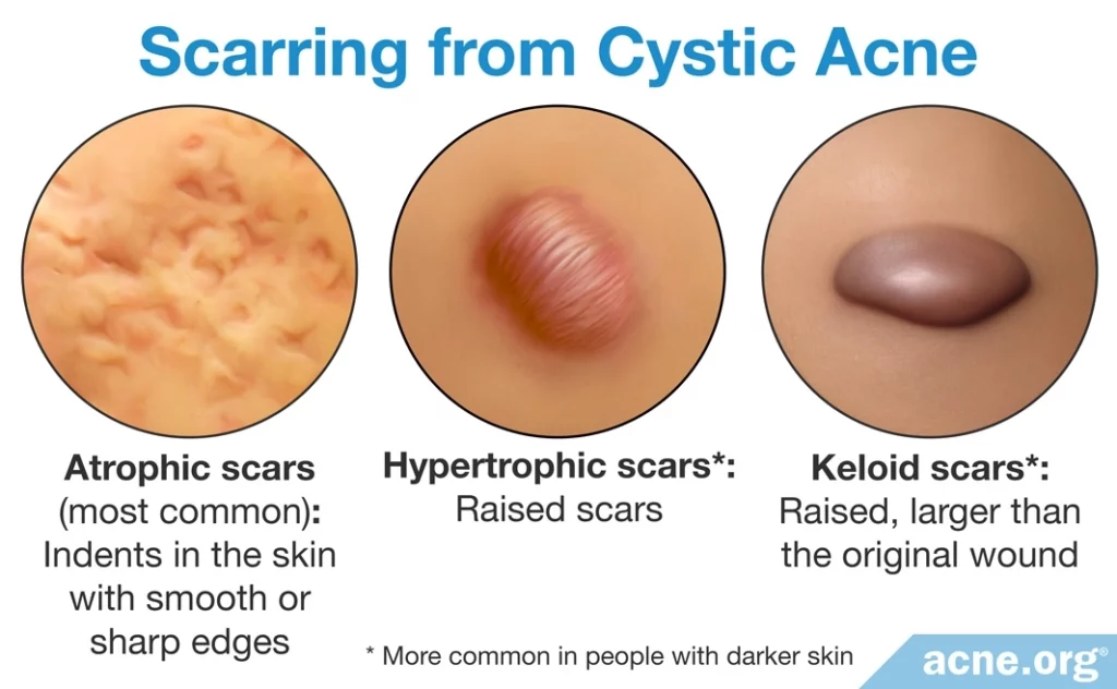 Scarring from Cystic Acne