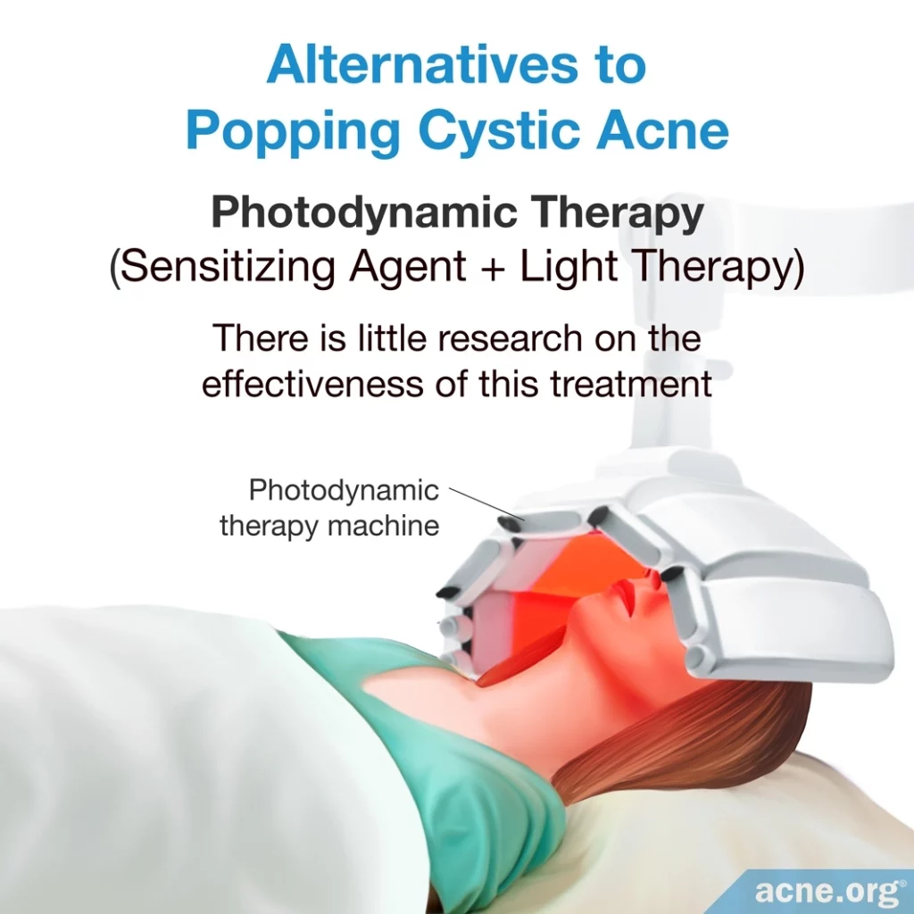 Alternativas al acné quístico reventado - Terapia fotodinámica