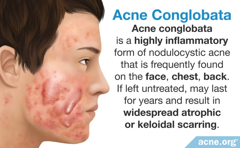 acné conglobata