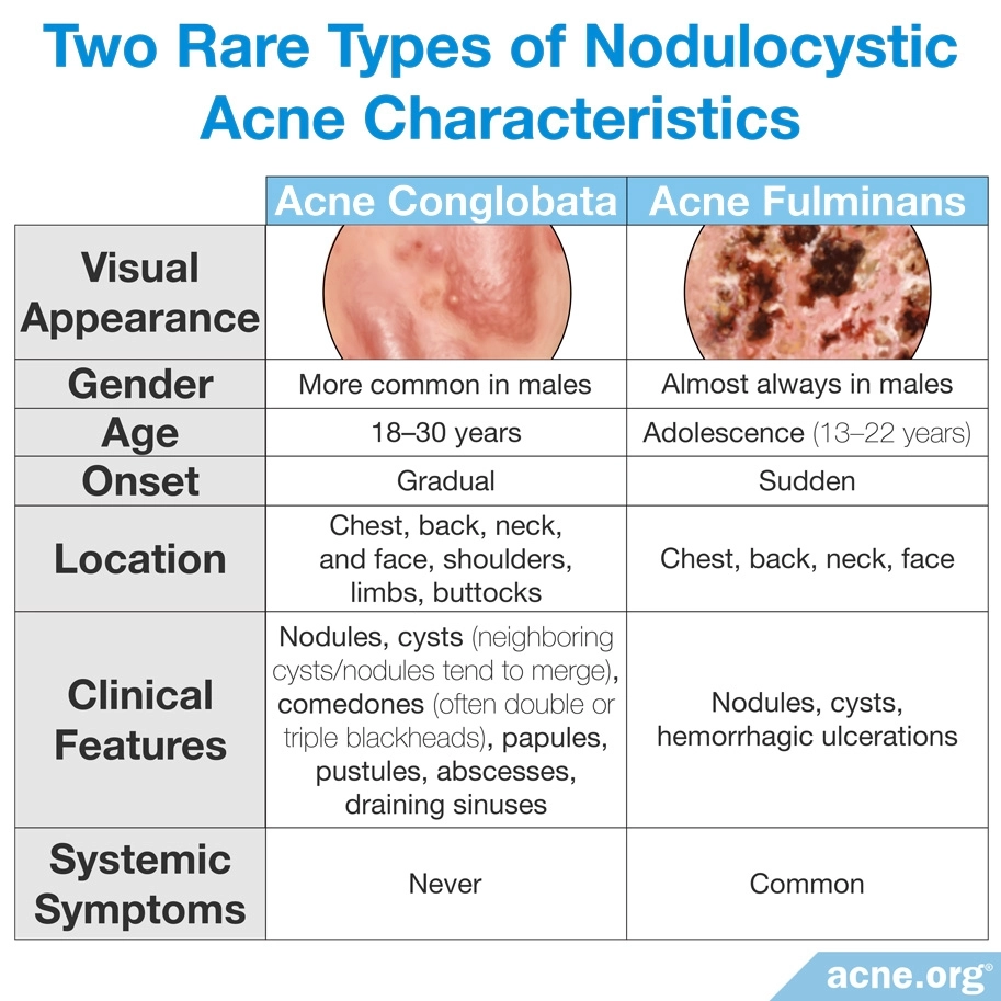 Dos tipos raros de características del acné noduloquístico