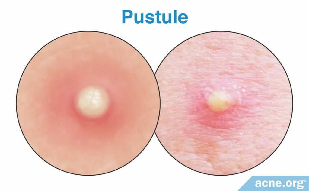 Pustule