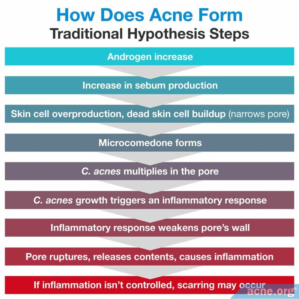 How Does Acne Form Traditional Hypothesis Steps