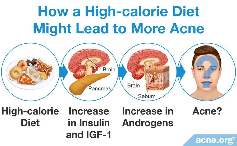 How a High-calorie Diet Might Lead to More Acne
