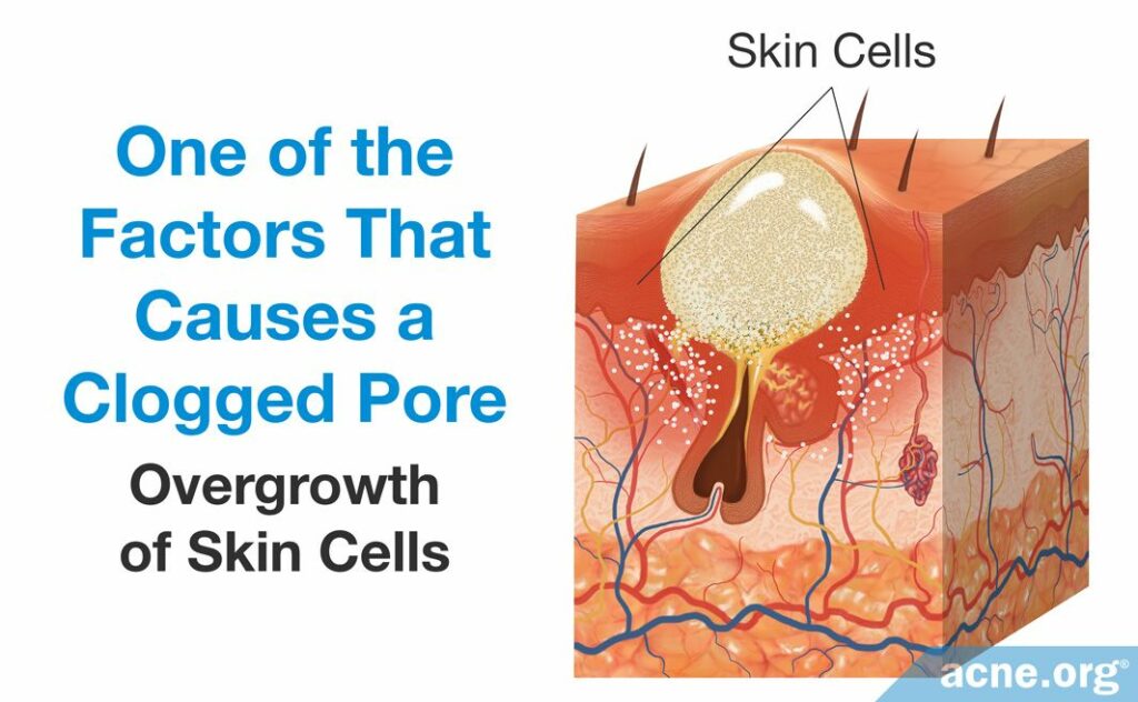 Overgrowth of Skin Cells Causes a Clogged Pore