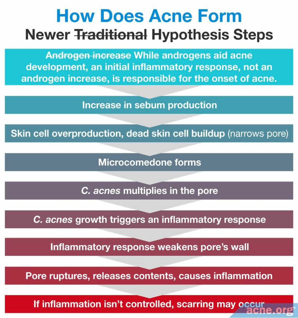 How Does Acne Form Newer Hypothesis Steps