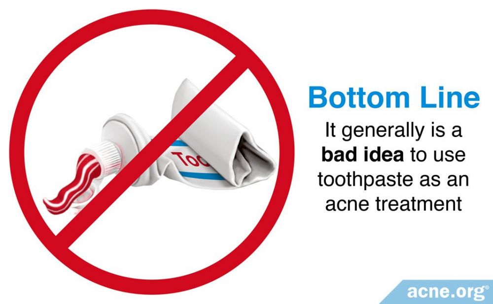 It Is Generally a Bad Idea to Use Toothpaste on Acne
