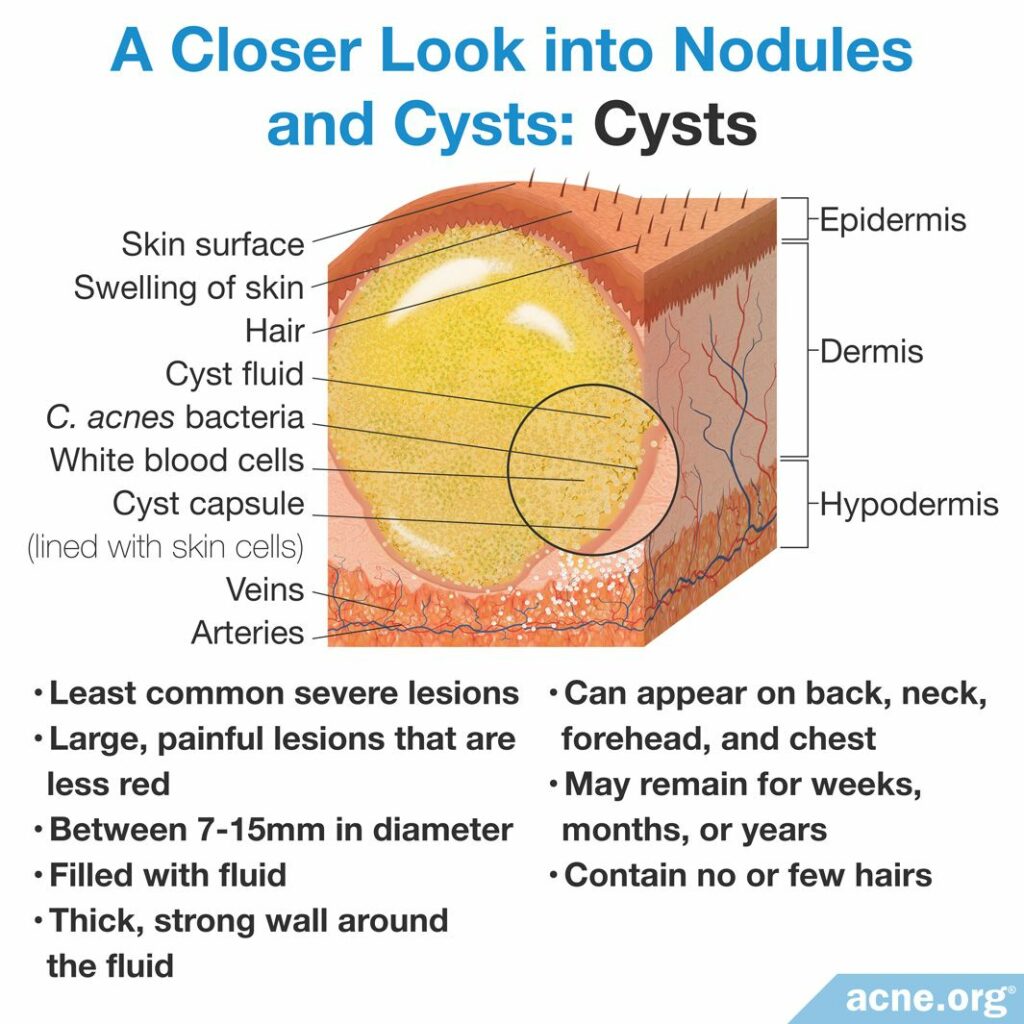 Acne Cyst